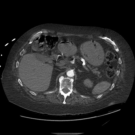 Aortoesophageal fistula with endovascular repair (Radiopaedia 73781-84592 Axial C+ CTPA 190).jpg
