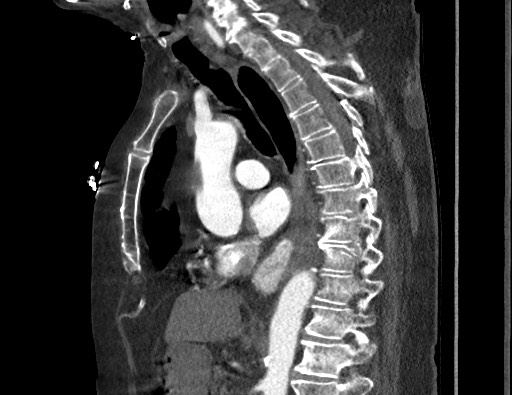 Aortoesophageal fistula with endovascular repair (Radiopaedia 73781-84592 Sagittal C+ CTPA 100).jpg