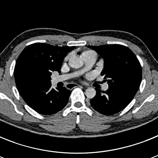 File:Apical lung mass mimic - neurogenic tumor (Radiopaedia 59918-67521 A 39).jpg