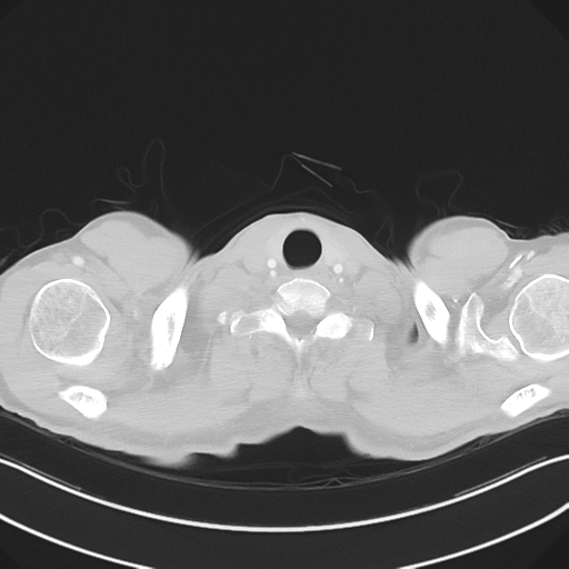 Apical pleural calcification (Radiopaedia 46141-50499 Axial lung window 2).png