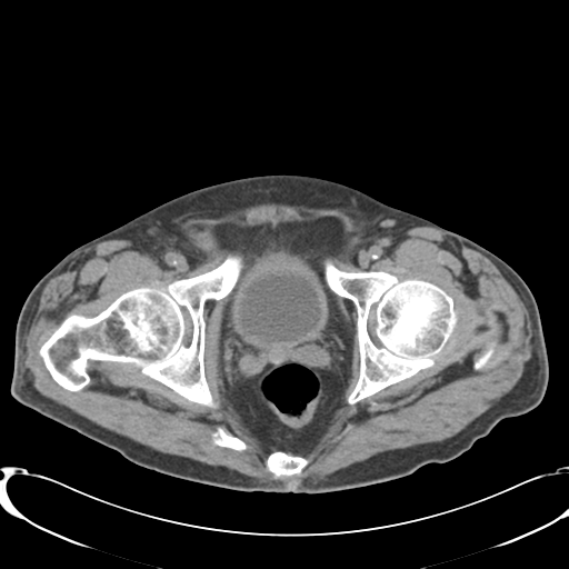 File:Appendiceal abscesses (Radiopaedia 50999-56542 Axial non-contrast 78).png