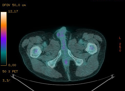 File:Appendiceal adenocarcinoma complicated by retroperitoneal abscess (Radiopaedia 58007-65041 Axial PET-CT 200).jpg