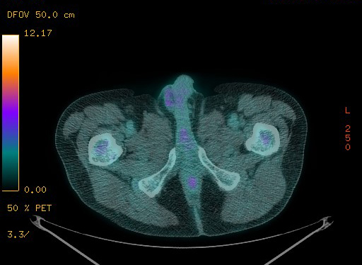Appendiceal adenocarcinoma complicated by retroperitoneal abscess (Radiopaedia 58007-65041 Axial PET-CT 201).jpg