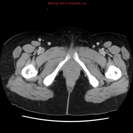 Appendiceal mucinous cystadenoma (Radiopaedia 8263-9111 Axial liver window 86).jpg