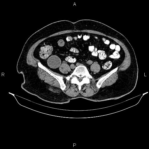 Appendiceal mucocele (Radiopaedia 82952-97298 A 70).jpg