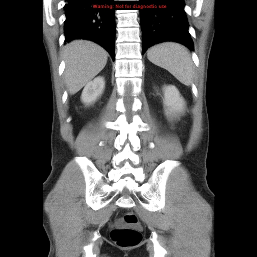 File:Appendicitis and renal cell carcinoma (Radiopaedia 17063-16760 B 24).jpg