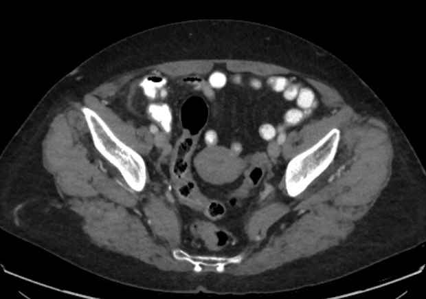 File:Appendicitis due to chicken fibula (Radiopaedia 74314-85198 A 40).jpg