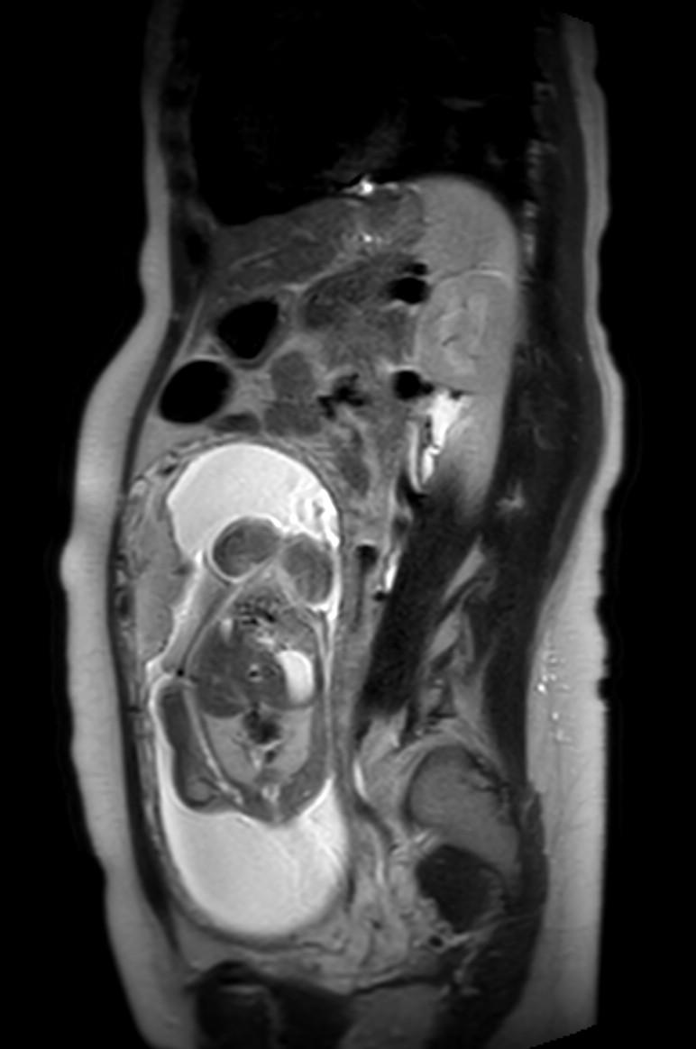 Appendicitis in gravida (MRI) (Radiopaedia 89433-106395 Sagittal T2 26).jpg