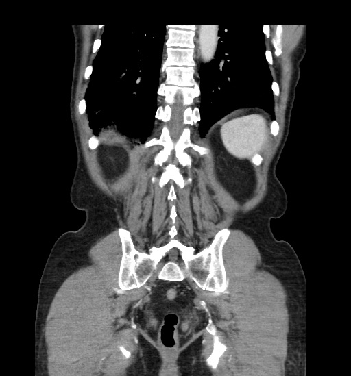 Appendicitis with localized perforation and abscess formation (Radiopaedia 49035-54130 B 40).jpg