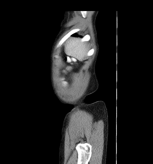 Appendicitis with localized perforation and abscess formation (Radiopaedia 49035-54130 C 4).jpg