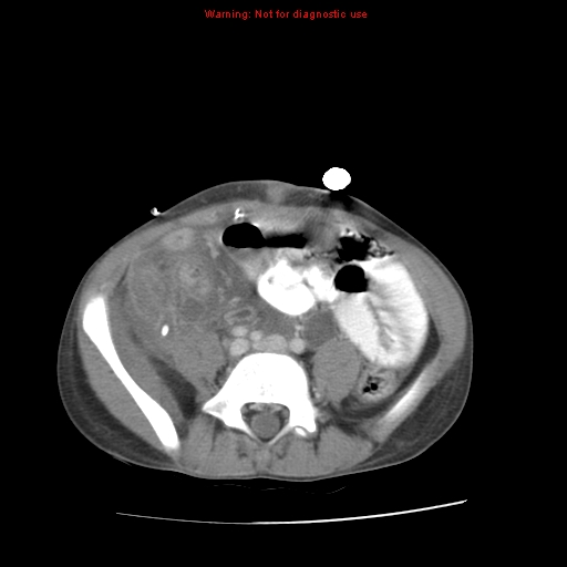 Appendicitis with phlegmon (Radiopaedia 9358-10046 A 48).jpg