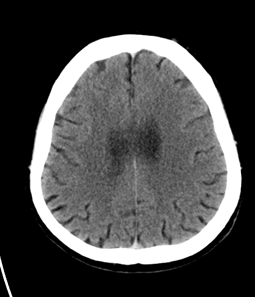 File:Aqueduct stenosis with corpus callosum hypoattenuation post shunting (Radiopaedia 37212-38973 Axial non-contrast 23).png