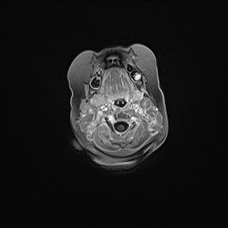 Aqueductal stenosis (Radiopaedia 73974-84802 Axial T1 C+ 21).jpg