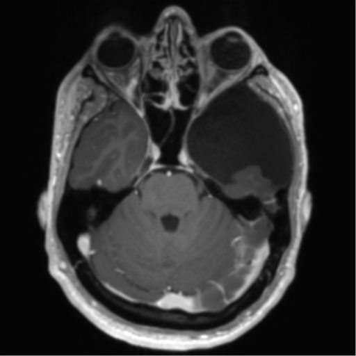 File:Arachnoid cyst with subdural hematoma (Radiopaedia 85892-101743 Axial T1 C+ 29).png