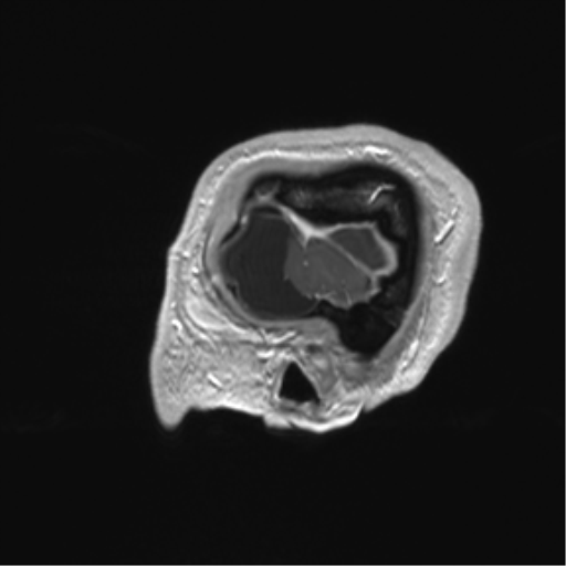 Arachnoid cyst with subdural hematoma (Radiopaedia 85892-101743 Sagittal T1 C+ 10).png