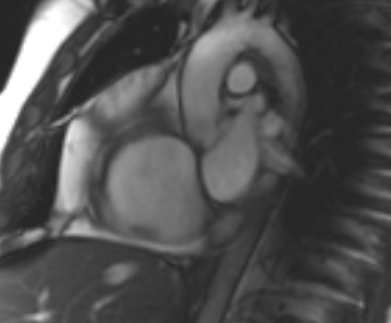 Arrhythmogenic right ventricular cardiomyopathy (Radiopaedia 69431-79307 Short axis cine 232).jpg