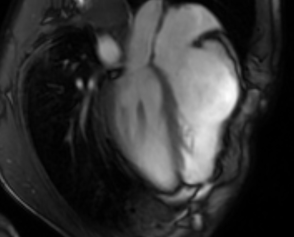 Arrhythmogenic right ventricular cardiomyopathy (Radiopaedia 69564-79464 4ch cine 83).jpg