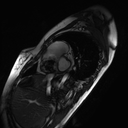 Arrhythmogenic right ventricular cardiomyopathy (Radiopaedia 87505-103850 short axis Cine SSFP 226).jpg