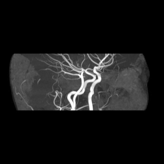 File:Artery of Percheron infarct (Radiopaedia 40966-43676 G 9).jpg