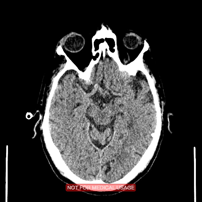 Artery of Percheron infarction (Radiopaedia 28679-28967 Axial non-contrast 48).jpg