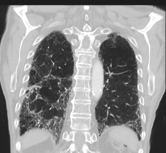 File:Asbestosis (Radiopaedia 56192-62864 Coronal lung window 40).png