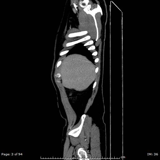 Ascending aortic aneurysm (Radiopaedia 50086-55404 C 2).jpg