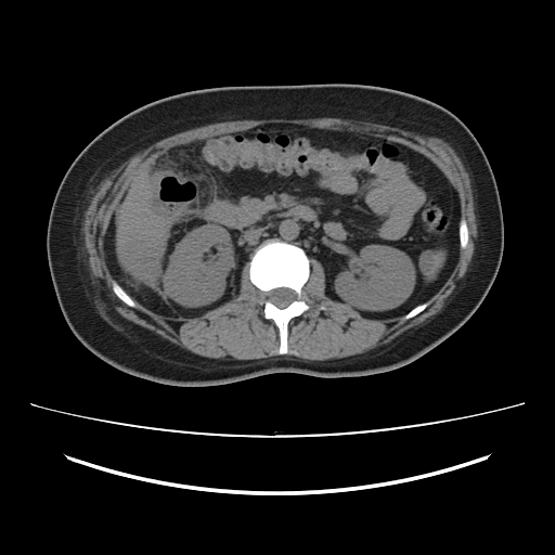Ascending retrocecal appendicitis with liver abscesses (Radiopaedia 60066-67615 Axial non-contrast 36).jpg