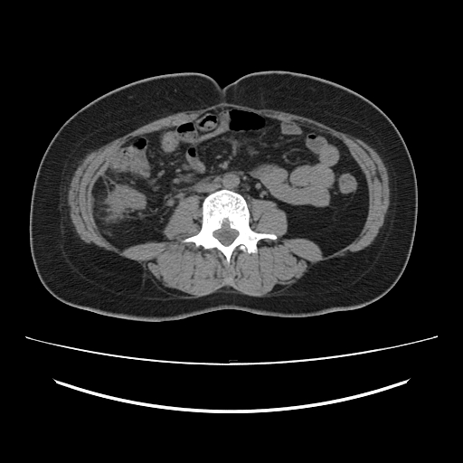Ascending retrocecal appendicitis with liver abscesses (Radiopaedia 60066-67615 Axial non-contrast 48).jpg