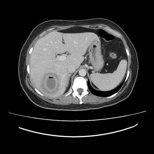 Ascending retrocecal appendicitis with liver abscesses (Radiopaedia 60066-67615 B 23).jpg