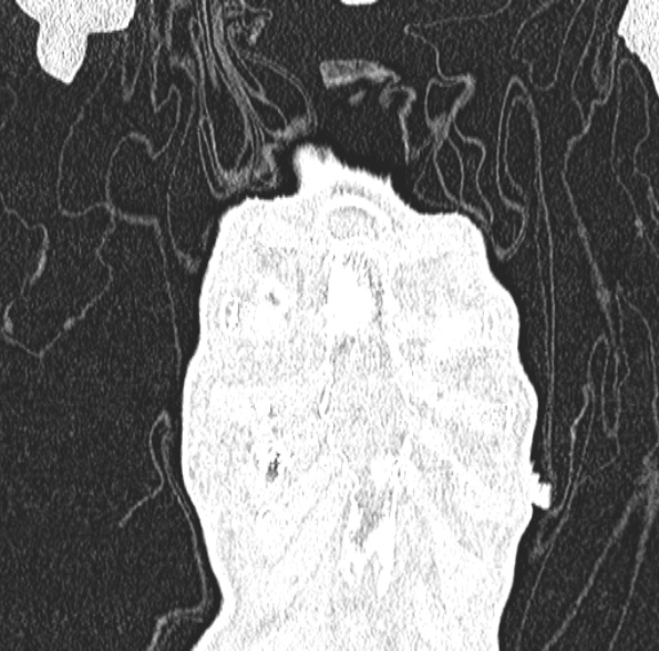 File:Aspergilloma- with Monod sign (Radiopaedia 44737-48532 Coronal lung window 121).jpg