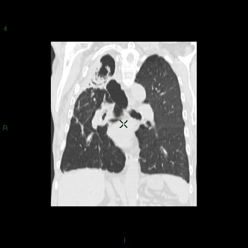 File:Aspergilloma (Radiopaedia 14842-14787 Coronal lung window 21).jpg