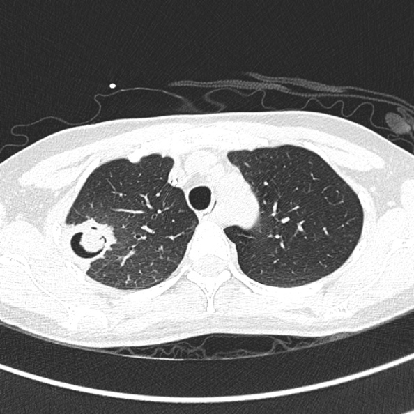 File:Aspergilloma (Radiopaedia 26223-26347 Axial lung window 21).jpg