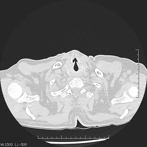 Aspergilloma (Radiopaedia 75184-86270 Axial lung window 1).jpg