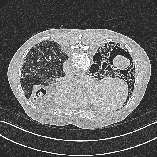File:Aspergilloma on background pulmonary fibrosis (Radiopaedia 60942-68757 Axial lung window 22).jpg