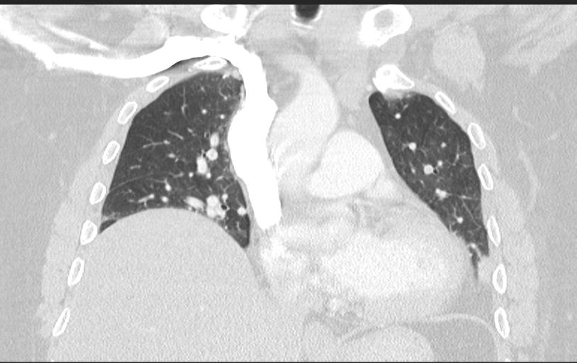 Aspirated tooth (Radiopaedia 28584-28844 Axial lung window 51).jpg