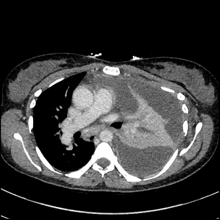 Aspiration pneumonia complicated by empyema (Radiopaedia 73024-83767 B 153).jpg