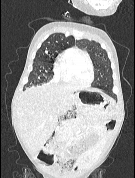 Asplenia syndrome (Radiopaedia 73083-83792 Coronal lung window 27).jpg