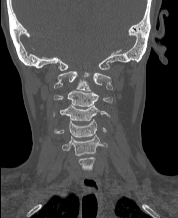 Atlanto-occipital assimilation with basilar invagination (Radiopaedia 70122-80188 Coronal bone window 107).jpg