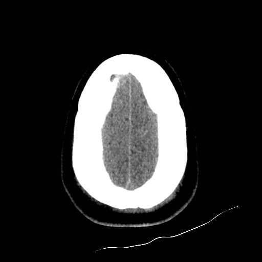 Atlanto-occipital dislocation (Radiopaedia 44648-48412 Axial non-contrast 49).jpg