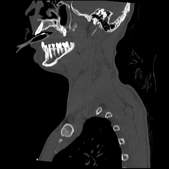 File:Atlanto-occipital dissociation (Traynelis type 1), C2 teardrop fracture, C6-7 facet joint dislocation (Radiopaedia 87655-104061 Sagittal bone window 15).jpg