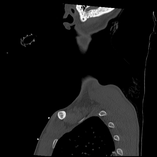 Atlanto-occipital dissociation (Traynelis type 1), C2 teardrop fracture, C6-7 facet joint dislocation (Radiopaedia 87655-104061 Sagittal bone window 68).jpg