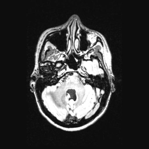 Atretic encephalocoele with inferior vermis hypoplasia (Radiopaedia 30443-31108 Axial 45).jpg