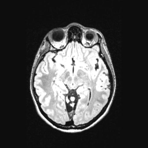 Atretic encephalocoele with inferior vermis hypoplasia (Radiopaedia 30443-31108 Axial 72).jpg