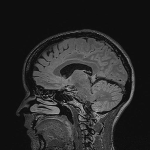 Atretic encephalocoele with inferior vermis hypoplasia (Radiopaedia 30443-31108 Sagittal FLAIR 75).jpg