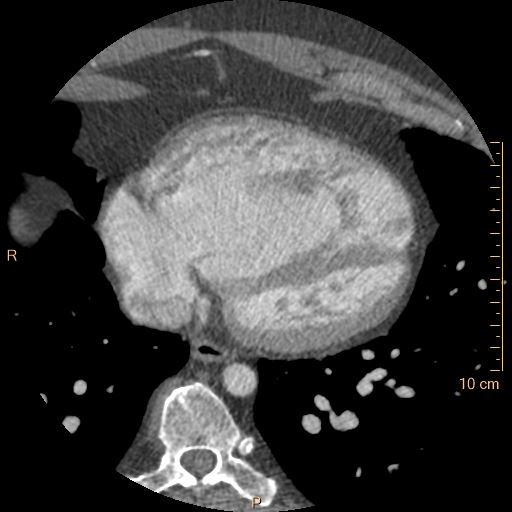File:Atrial septal defect (upper sinus venosus type) with partial anomalous pulmonary venous return into superior vena cava (Radiopaedia 73228-83961 A 204).jpg