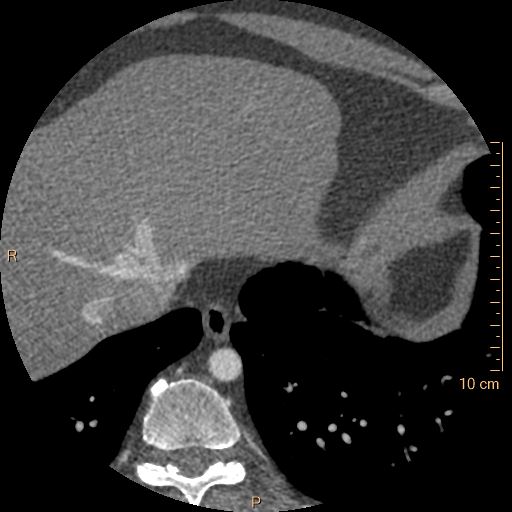File:Atrial septal defect (upper sinus venosus type) with partial anomalous pulmonary venous return into superior vena cava (Radiopaedia 73228-83961 A 260).jpg