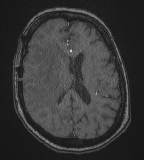 Atypical meningioma (WHO Grade II) (Radiopaedia 54742-60981 Axial MRA 61).png
