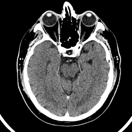 Atypical meningioma (WHO grade II) with brain invasion (Radiopaedia 57767-64728 Axial C+ 36).png