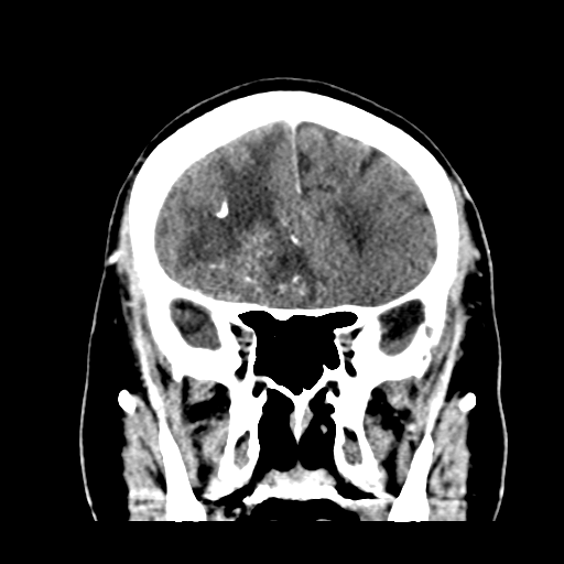 Atypical meningioma (WHO grade II) with brain invasion (Radiopaedia 57767-64728 Coronal C+ 20).png