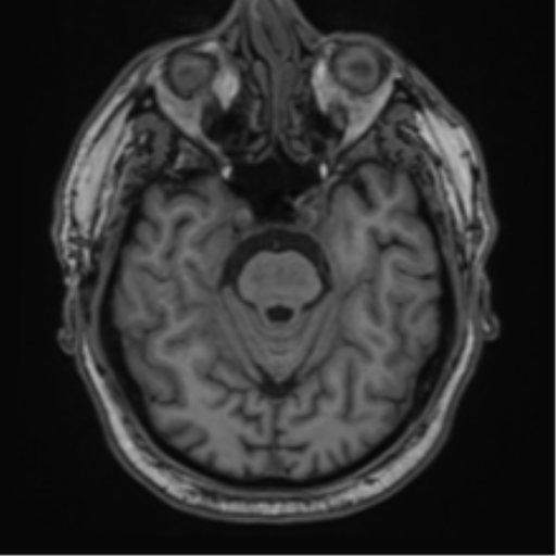 File:Atypical meningioma (WHO grade II) with brain invasion (Radiopaedia 57767-64729 Axial T1 15).png